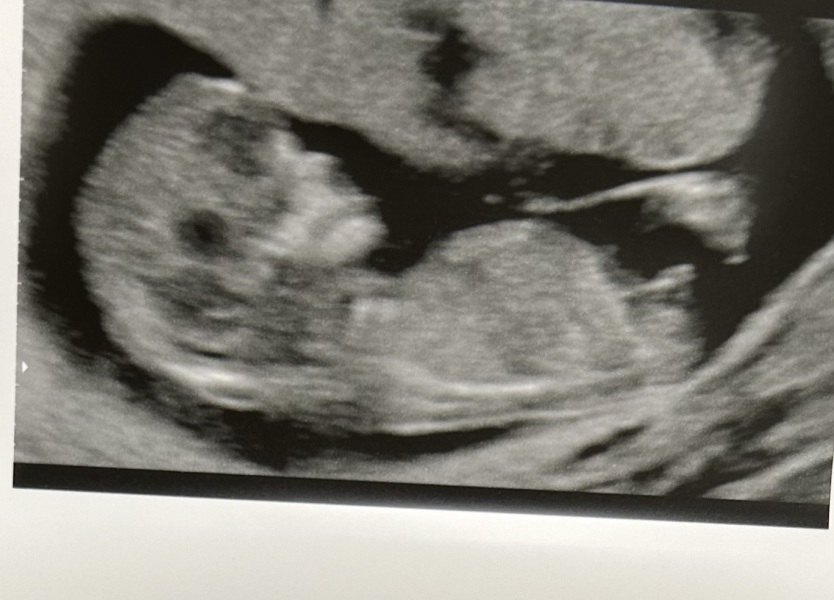 Boy or girl nub theory?? Xxxxx