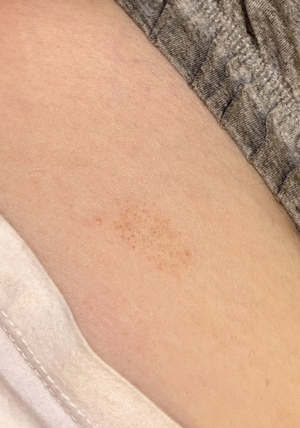 What is this weird rash? (Pic included)