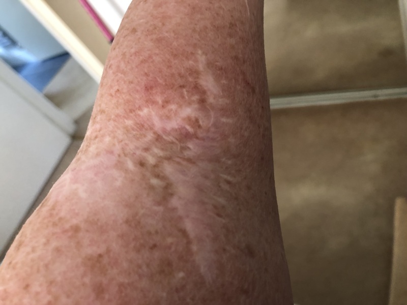To wonder about sunburnt children before suncream was popularised?