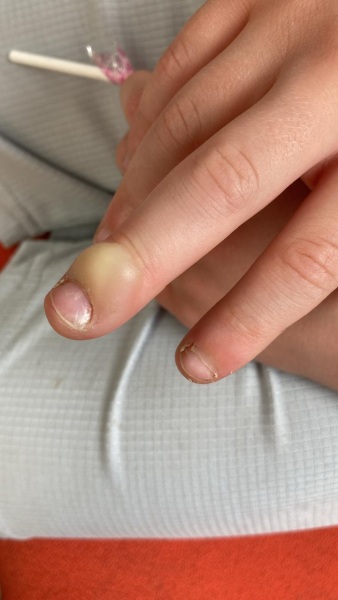 Suggestions of how to burst this