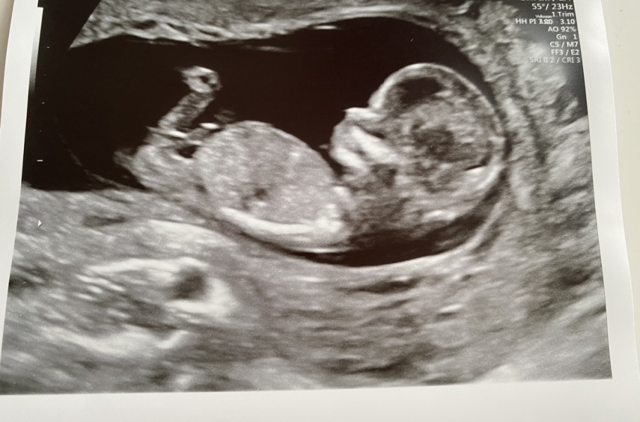 Gender guesses - 12 week scan