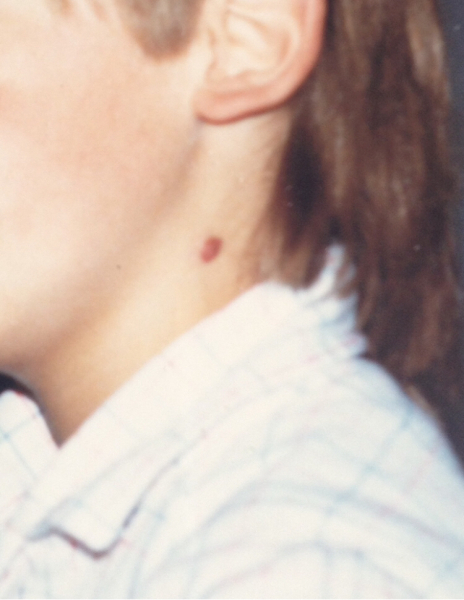 Daughters Hemangioma (with pic)
