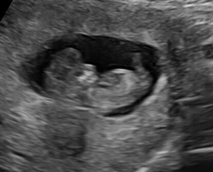 Skull theory gender at 11 weeks?
