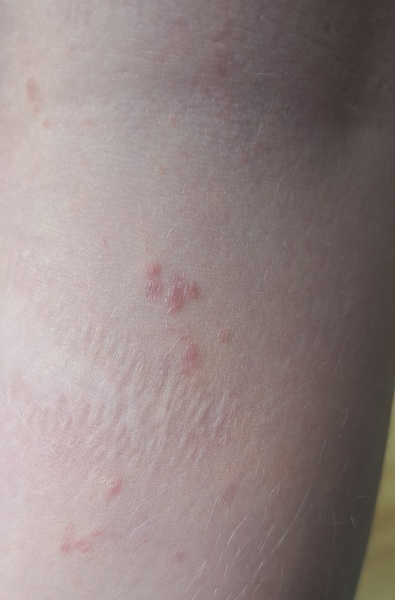 What are these marks/spots? Molluscum?