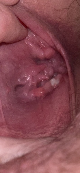 TMI pic - what are these lumps coming out my vagina !?