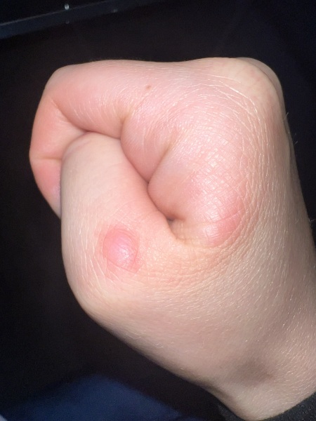 What is this on my knuckle?