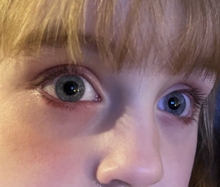 Toddler with chalazion on eye (picture)