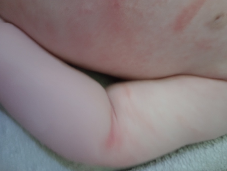 Aptamil Pepti 1 making eczema worse! 