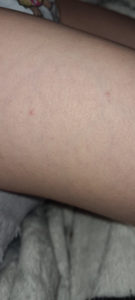 Is this chicken pox