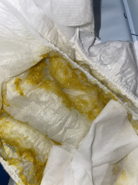 Vinegary/fishy mucus poo, Could this be CMPA? Gross Pic included