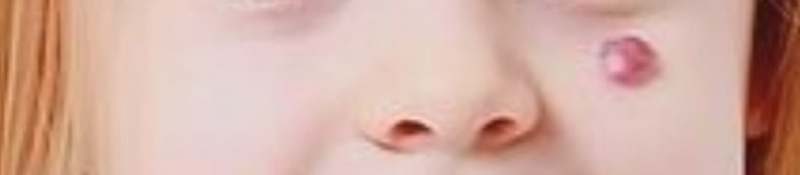 Daughters Hemangioma (with pic)