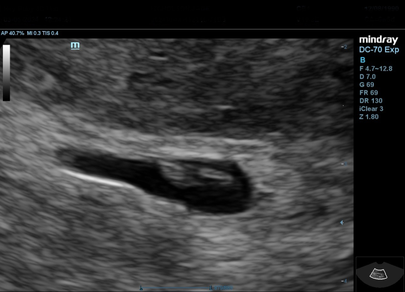 Pregnancy after loss support