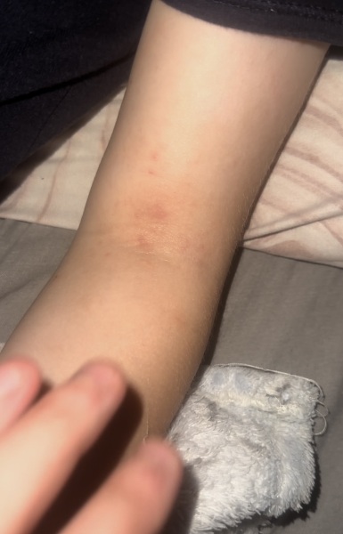 Potential Chickenpox