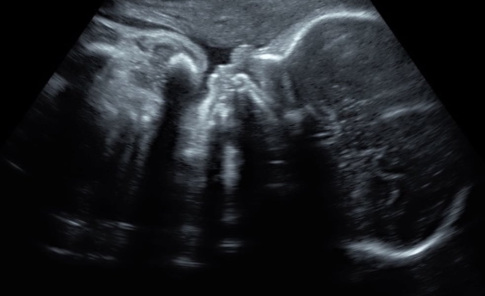 Really regret getting my 3d ultrasounds - short femur length