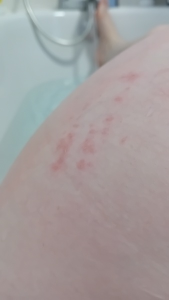 Any idea about this rash?