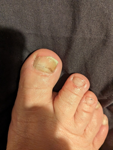 this could be subungual melanoma