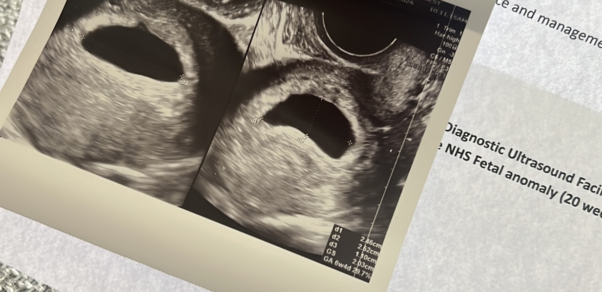 Potential Blighted Ovum