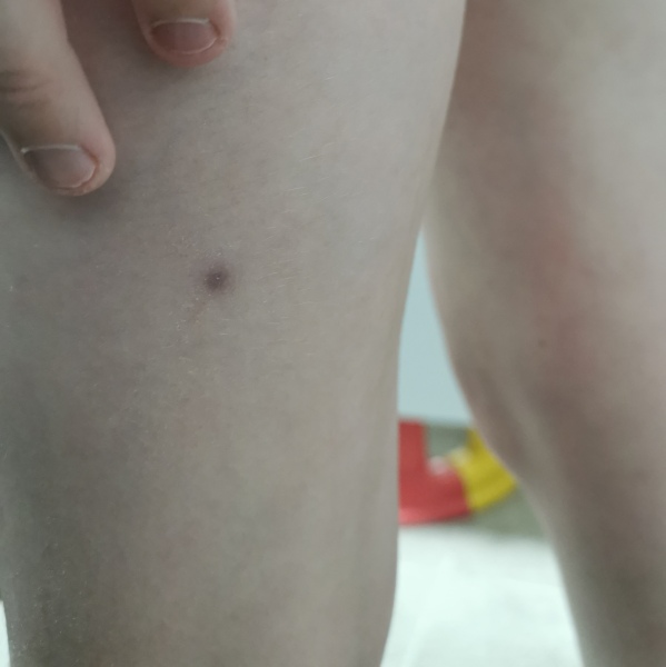 Anybody know what is this that has appeared on my daughters leg?