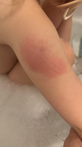 Posted earlier do I need to seek advice from doctor ?