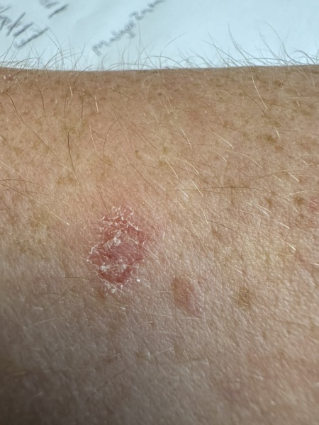 Dodgy skin patch - would this worry you!?