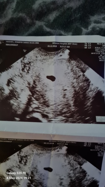 5+3 Ultrasound - gestational sac, chorion, potentially no yolk sac??