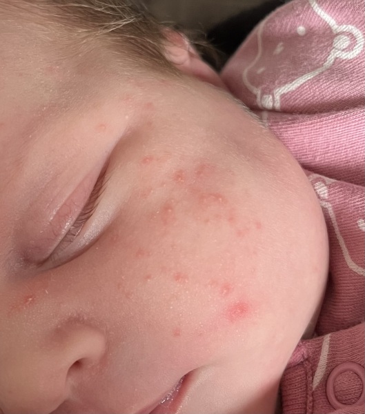 Baby acne?