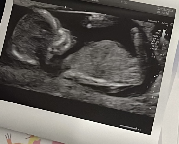 Told boy at 15 weeks and girl at 20 week scan