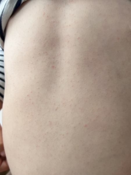 What is this rash?