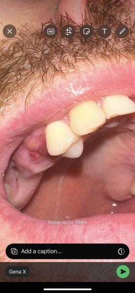 Dentis anyone TMI