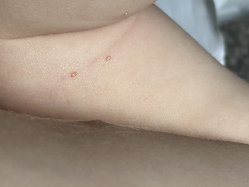 Chicken pox or molloscum?