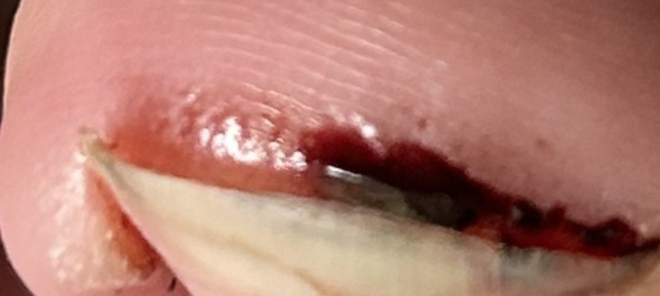 Toe nail. Very gross Photo attached