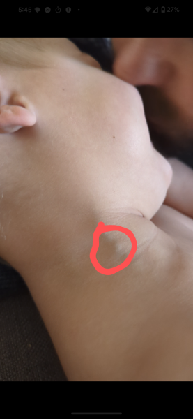 Bulge in neck when laughing or crying