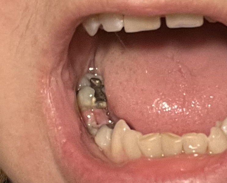 Should I go back to dentist, or is this normal?