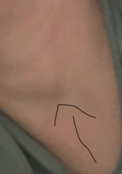Lump on neck