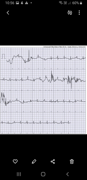 Can anyone have a look at this EKG??