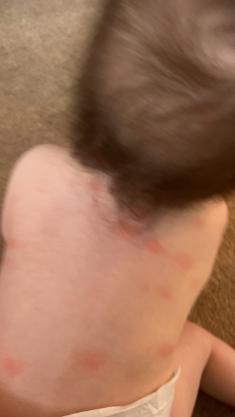Heat rash or ?