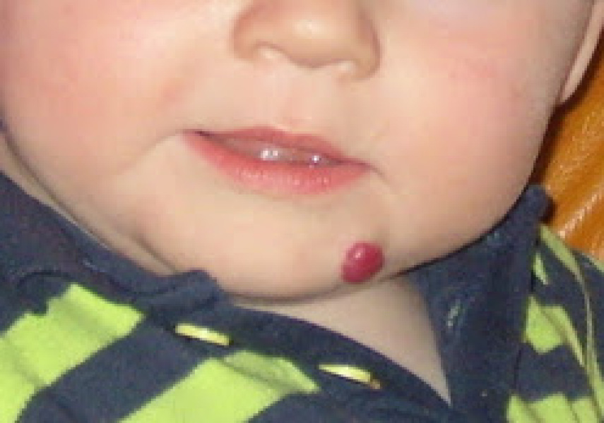 Daughters Hemangioma (with pic)