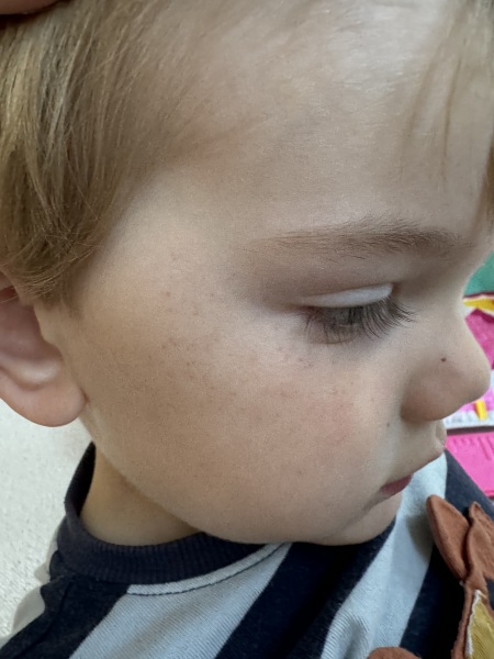 Purple rash on sons face