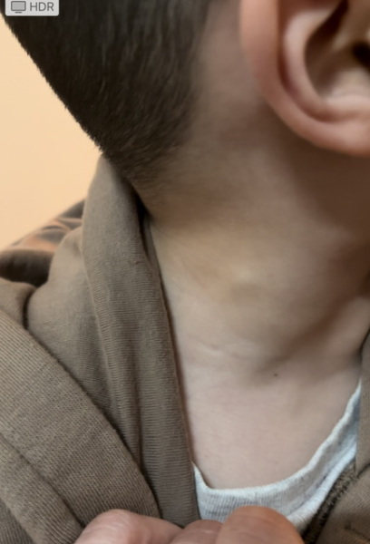 Bulge in neck when laughing or crying