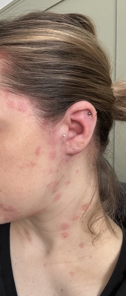 What is causing this yearly flare up?