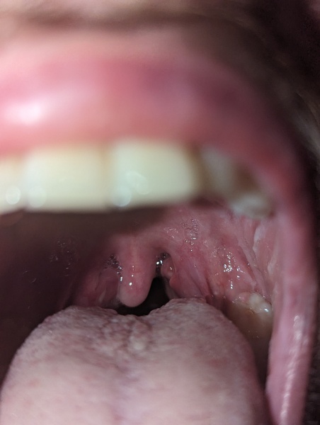 Tonsillitis or quinsy? How can I tell?