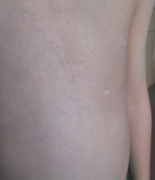What are these spots? Heatrash or a.n.other
