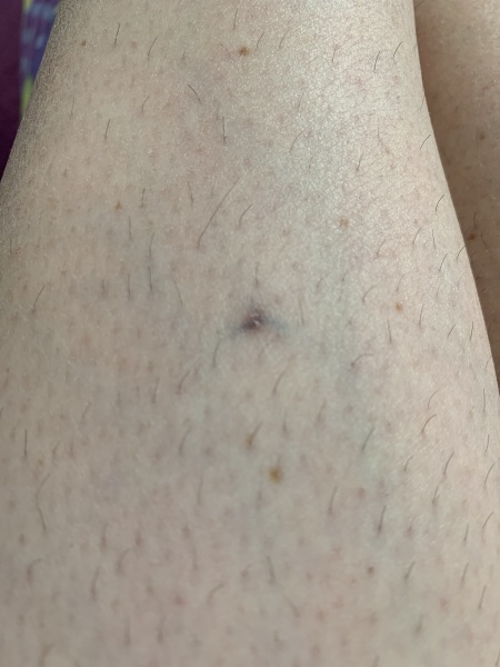 Anybody know what is this that has appeared on my daughters leg?