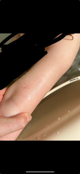 This rash on 3 year old