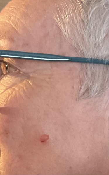 Weird insect bite on face? (Piccy included)