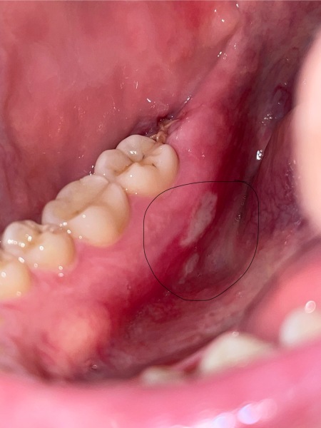 Ulcers after tooth removal