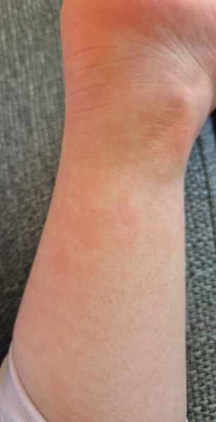 Rash on hands and feet