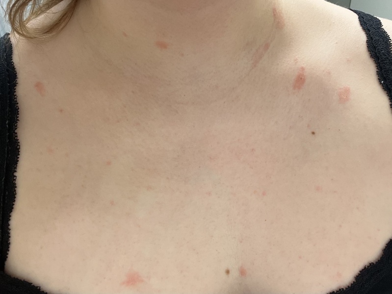 Any rash experts about?