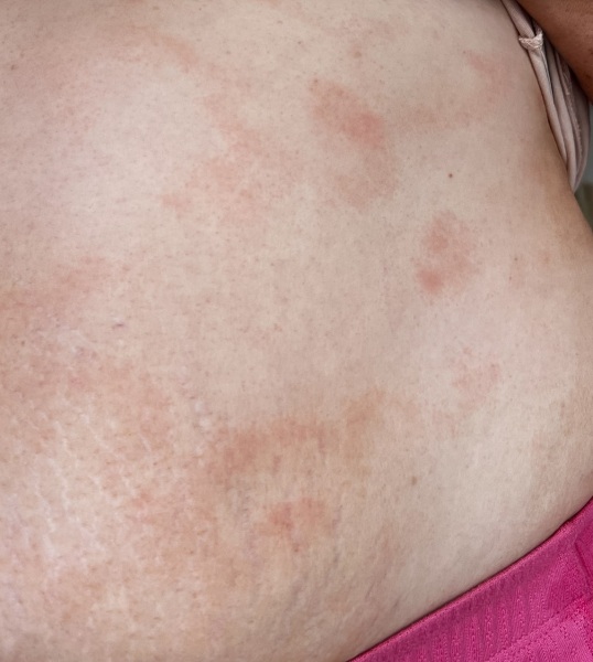What is this rash on my stomach? Photos attached