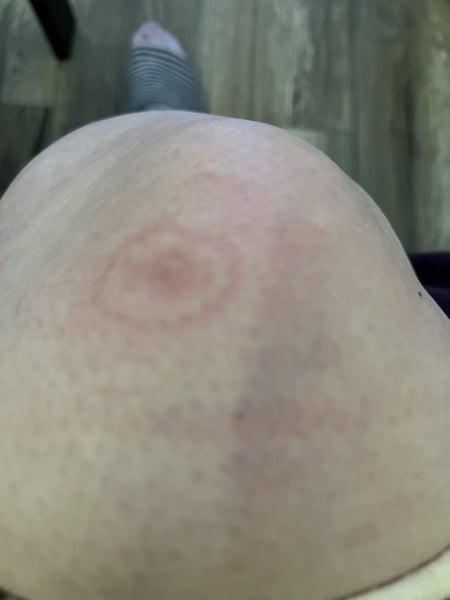 possible Lyme disease?